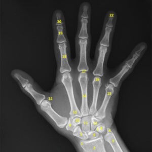 1.	Styloid process of radius.
2.	Metaphysis of radius.
3.	Metaphysis of ulna.
4.	Styloid process of ulna.
5.	Scaphoid.
6.	Lunate.
7.	Triquetrum.
8.	Pisiform.
9.	Trapezium.
10.	Trapezoid.
11.	Capitate.
12.	Hamate.
13.	Base of second metacarpal.
14.	Shaft of third metacarpal.
15.	Neck of fifth metacarpal.
16.	Head of forth metacarpal.
17.	Metacarpophalangeal joint.
18.	Proximal phalanx.
19.	Middle phalanx.
20.	Distal phalanx.
21.	Sesamoid bones (flexor pollicis brevis, adductor pollicis).
22.	Terminal tuft hand radiograph annotated