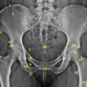 1.	Iliac crest
2.	Ilium
3.	Anterior sacral foramina
4.	Sacroiliac joint
5.	Anterior superior iliac spine
6.	Anterior inferior iliac spine
7.	Ischial spine
8.	Superior pubic ramus
9.	Obturator foramen
10.	Inferior pubic ramus
11.	Ischial tuberosity
12.	Symphysis pubis
13.	Coccyx
14.	Femur
15.	Lesser trochanter
16.	Greater trochanter
17.	Femoral neck
18.	Femoral head
19.	Acetabulum pelvis radiograph annotated