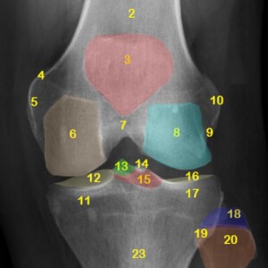 1.	Femoral shaft.
2.	Distal femoral metaphysis.
3.	Patella.
4.	Adductor tubercle.
5.	Medial femoral epicondyle.
6.	Medial condyle.
7.	Intercondylar notch.
8.	Lateral condyle.
9.	Popliteal groove.
10.	Lateral femoral epicondyle.
11.	Medial condyle of tibia.
12.	Medial tibial plateau
13.	Medial tibial spine.
14.	Lateral tibial spine.
15.	Intercondylar eminence (Tibial eminence).
16.	Lateral tibial plateau.
17.	Lateral condyle of tibia.
18.	Fibular styloid process.
19.	Proximal tibiofibular joint.
20.	Fibular head.
21.	Fibular neck.
22.	Tibial shaft.
23.	Tibial proximal metaphysis.
24.	Quadriceps tendon.
25.	Base of patella.
26.	Appex of patella.
27.	Patellar ligament.
28.	Infrapatellar fat pad (Hoffa's fat pad).
29.	Fabella.
30.	Tibial tuberosity. knee radiograph annotated