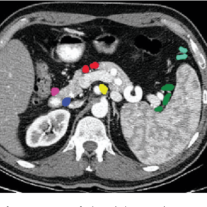 Yellow: coeliac axis -- Green: splenic -- Light blue: greater omental -- Pink: anterior pancreaticoduodenal -- Blue: posterior pancreaticoduodenal -- Red: pancreatic inferior Radiology abdominal lymph node stations