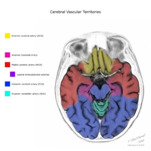 Case courtesy of Frank Gaillard, Radiopaedia.org, rID: 10814 cerebral vascular territories diagram