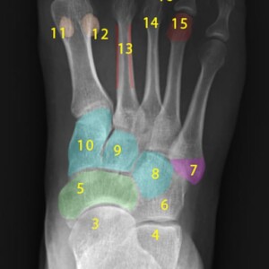 1.	Medial malleolus
2.	Lateral malleolus
3.	Head of talus
4.	Calcaneus
5.	Navicular
6.	Cuboid
7.	Base of fifth metatarsal
8.	Third cuneiform (lateral)
9.	Second cuneiform (Intermediate)
10.	First cuneiform (medial)
11.	Medial sesamoid
12.	Lateral sesamoid
13.	Shaft of second metatarsal
14.	Neck of third metatarsal
15.	Head of fourth metatarsal
16.	Metatarsophalangeal joint
17.	Proximal phalanx
18.	Middle phalanx
19.	Distal phalanx foot radiograph annotated