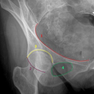 1.	iliopectineal line
2.	posterior acetabular wall
3.	acetabular roof
4.	obturator foramen Hip radiograph annotated
