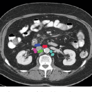 Light blue: lateral aortic -- Green: retrocaval -- Pink: lateral caval -- Red: pre-aortic -- Dark blue: pre-caval Radiology abdominal lymph node stations