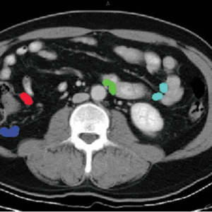 Green: inferior mesenteric -- Light blue: juxtaintestinal -- Red: anterior ileocolic -- Dark blue: posterior ileocolic Radiology abdominal lymph node stations