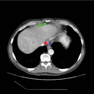 Green: anterior diaphragmatic -- Blue: gastro-oesophageal -- Red: middle diaphragmatic Radiology abdominal lymph node stations