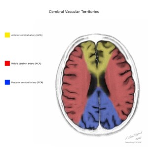 Case courtesy of Frank Gaillard, Radiopaedia.org, rID: 10814 cerebral vascular territories diagram