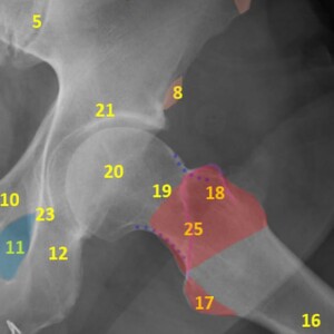 1. Iliac crest
2. Posterior superior iliac spine
3. Ilium
4. Anterior sacral foramina
5. Sacroiliac joint
6. Sacral Arcuate lines
7. Anterior superior iliac spine
8. Anterior inferior iliac spine
9. Ischial spine
10. Superior pubic ramus
11. Obturator foramen
12. Inferior pubic ramus
13. Ischial tuberosity
14. Symphysis pubis
15. Coccyx
16. Femur
17. Lesser trochanter
18. Greater trochanter
19. Femoral neck
20. Femoral head
21. Acetabulum
22. Fovea centralis
23. Koehler's teardrop
24. Psoas fat pad
25. Intertrochanteric crest
26. Gluteal fat pad hip radiograph annotated