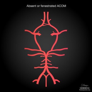 Absent/fenestrated ACOM Circle of willis diagram