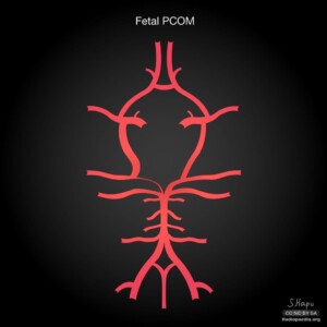 Fetal PCOM Circle of willis diagram