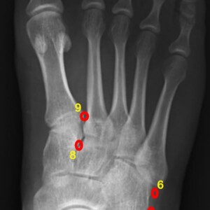 Common accessory ossicles ot the foot:
1.	os trigonum
2.	os supratalare
3.	os supranaviculare
4.	os calcaneus secundaris
5.	os peroneum
6.	os vesalianum
7.	os tibiale externum
8.	os intercuneiforme
9.	os intermetatarseum