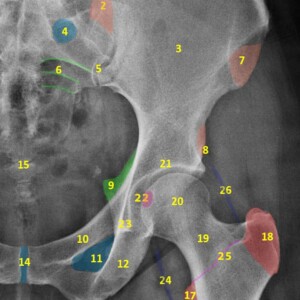 1.	Iliac crest
2.	Posterior superior iliac spine
3.	Ilium
4.	Anterior sacral foramina
5.	Sacroiliac joint
6.	Sacral Arcuate lines
7.	Anterior superior iliac spine
8.	Anterior inferior iliac spine
9.	Ischial spine
10.	Superior pubic ramus
11.	Obturator foramen
12.	Inferior pubic ramus
13.	Ischial tuberosity
14.	Symphysis pubis
15.	Coccyx
16.	Femur
17.	Lesser trochanter
18.	Greater trochanter
19.	Femoral neck
20.	Femoral head
21.	Acetabulum
22.	Fovea centralis
23.	Koehler's teardrop
24.	Psoas fat pad
25.	Intertrochanteric crest
26.	Gluteal fat pad hip radiograph annotated