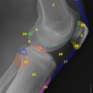 1.	Femoral shaft.
2.	Distal femoral metaphysis.
3.	Patella.
4.	Adductor tubercle.
5.	Medial femoral epicondyle.
6.	Medial condyle.
7.	Intercondylar notch.
8.	Lateral condyle.
9.	Popliteal groove.
10.	Lateral femoral epicondyle.
11.	Medial condyle of tibia.
12.	Medial tibial plateau
13.	Medial tibial spine.
14.	Lateral tibial spine.
15.	Intercondylar eminence (Tibial eminence).
16.	Lateral tibial plateau.
17.	Lateral condyle of tibia.
18.	Fibular styloid process.
19.	Proximal tibiofibular joint.
20.	Fibular head.
21.	Fibular neck.
22.	Tibial shaft.
23.	Tibial proximal metaphysis.
24.	Quadriceps tendon.
25.	Base of patella.
26.	Appex of patella.
27.	Patellar ligament.
28.	Infrapatellar fat pad (Hoffa's fat pad).
29.	Fabella.
30.	Tibial tuberosity. knee radiograph annotated