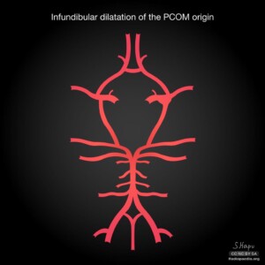 Infundibular dilatation of PCOM origin Circle of willis diagram
